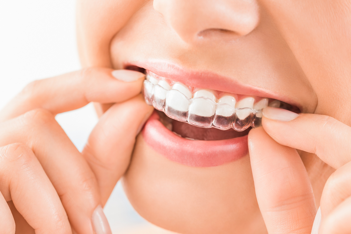 Porcelain Laminate Veneers and Crowns